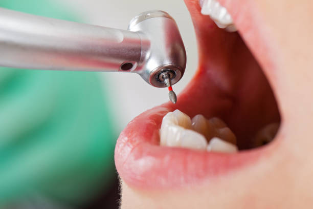 Best Emergency Dentist for Lost Fillings or Crowns in Washington Park, IL